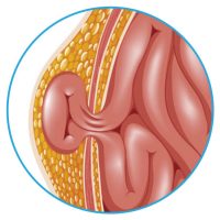 Hernia epigástrica