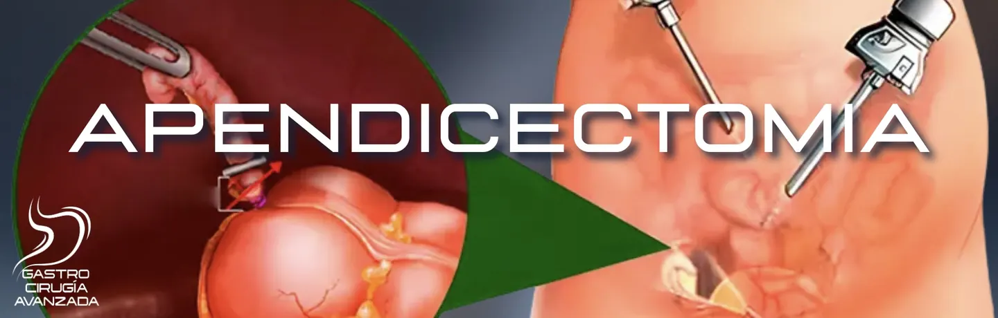 Apendicectomía laparoscópica en Guadalajara - Cirugía de apéndice Dr. López