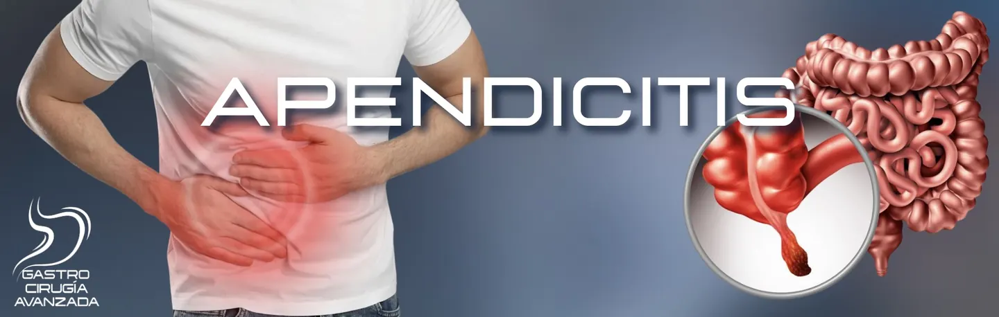 Apendicitis