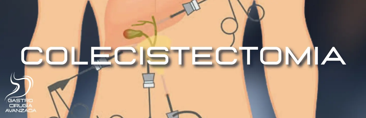 Colecistectomía Laparoscópica en Guadalajara
