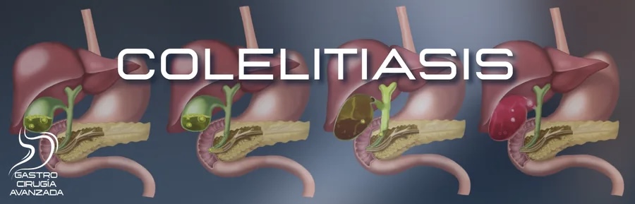 Colelitiasis vesícula