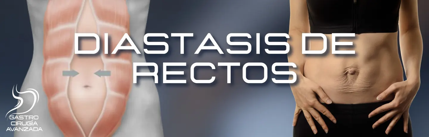 Diástasis Rectos Abdominales Guadalajara