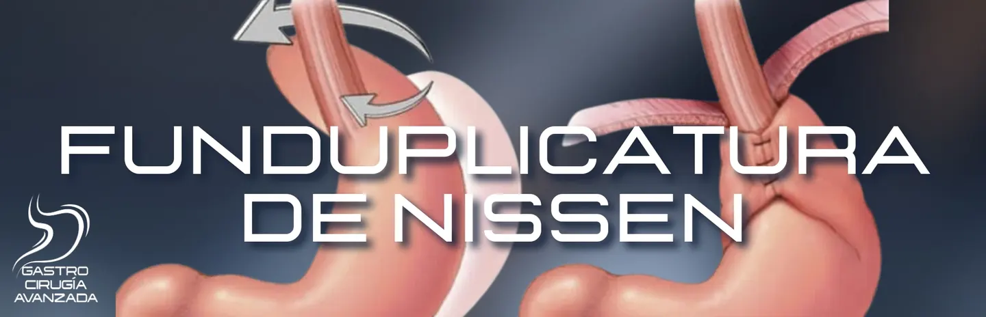 Funduplicatura de Nissen para reflujo gastroesofágico en Guadalajara - Dr. López