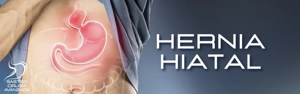 Cirugía de hernia hiatal y reflujo gastroesofágico en Guadalajara - Dr. Alejandro López