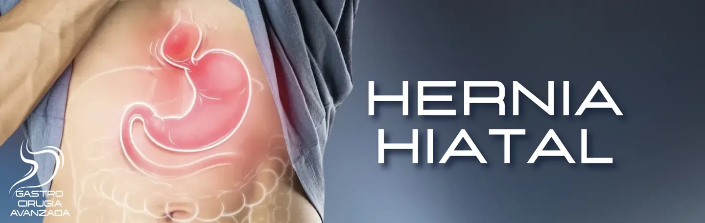 Hernia hiatal