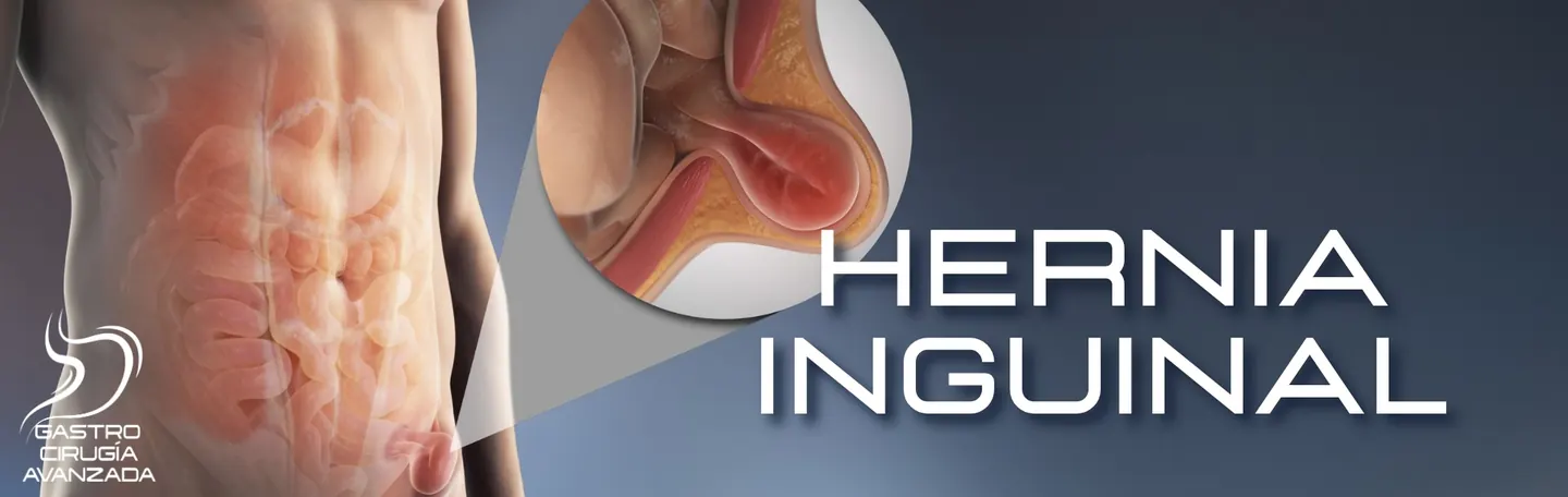 Hernia inguinal