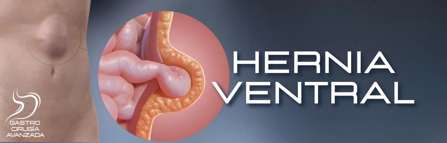 Hernia ventral