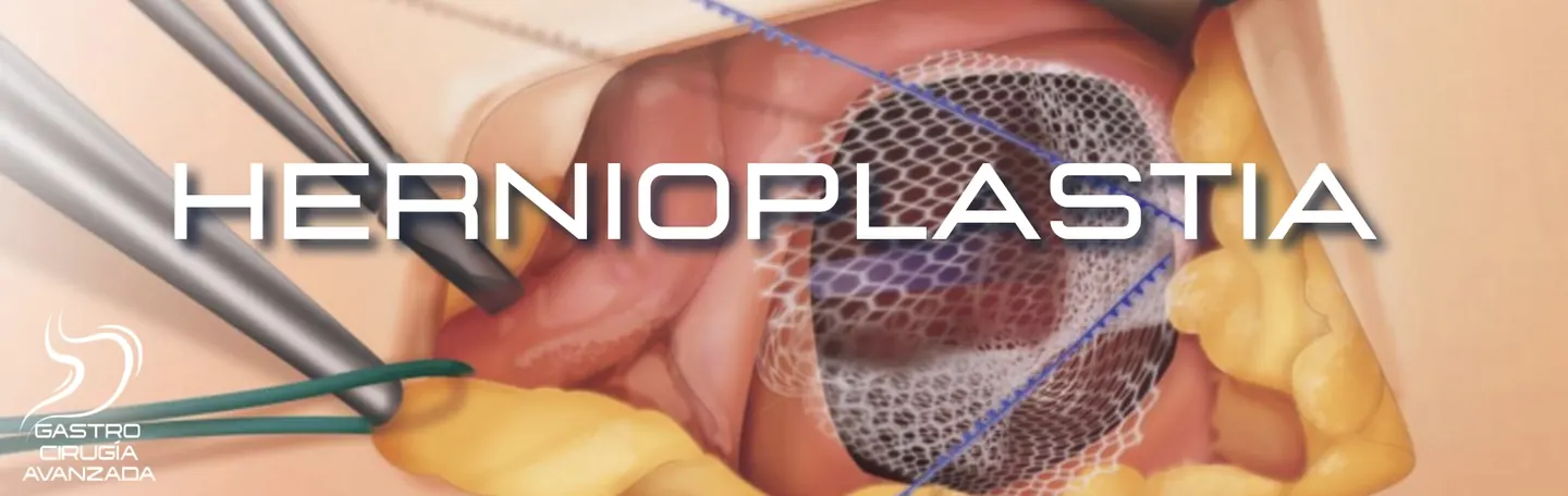 Hernioplastia laparoscópica cirugía de hernia inguinal umbilical y ventral en Guadalajara