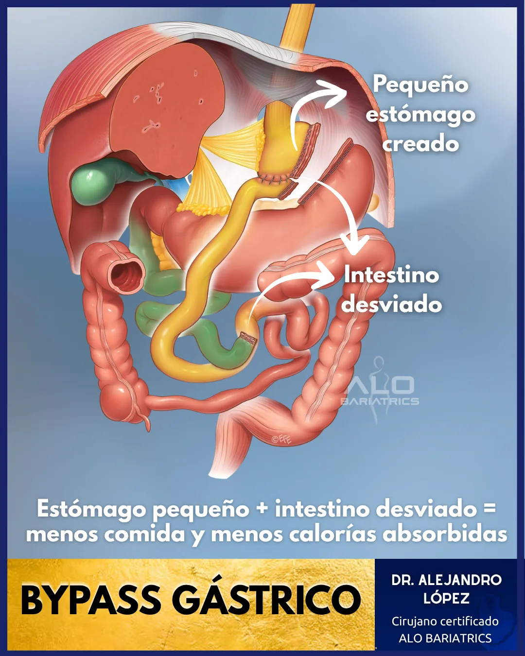 Bypass gástrico en México