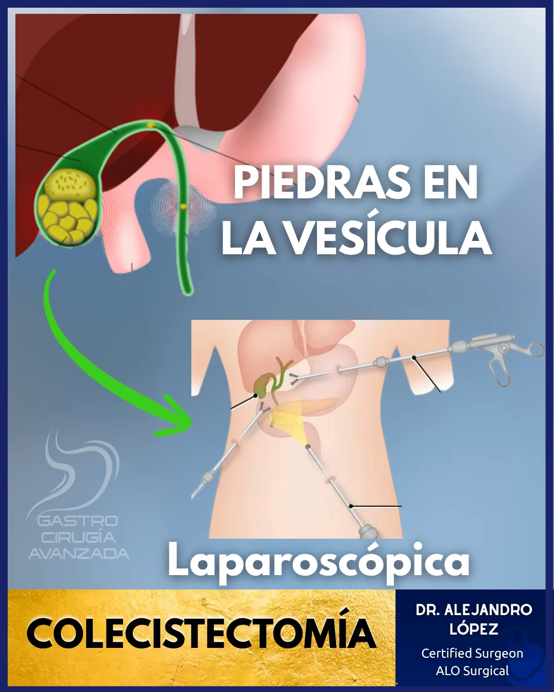 Colecistectomía laparoscópica — cálculo biliar en México