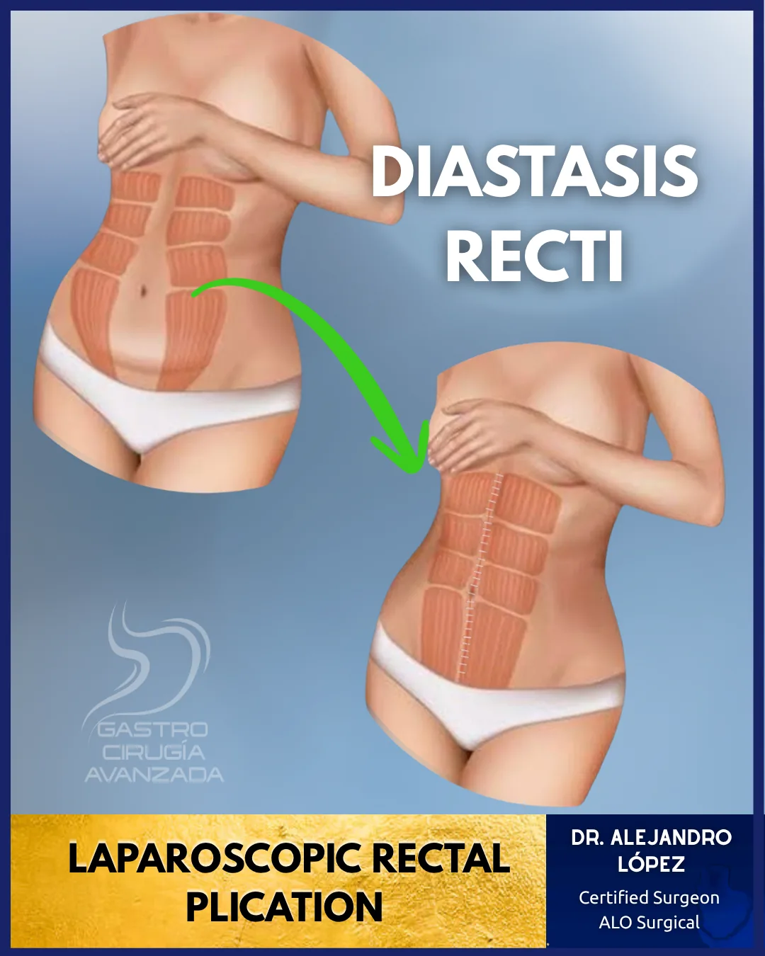Laparoscopic diastasis recti plication surgery in Mexico