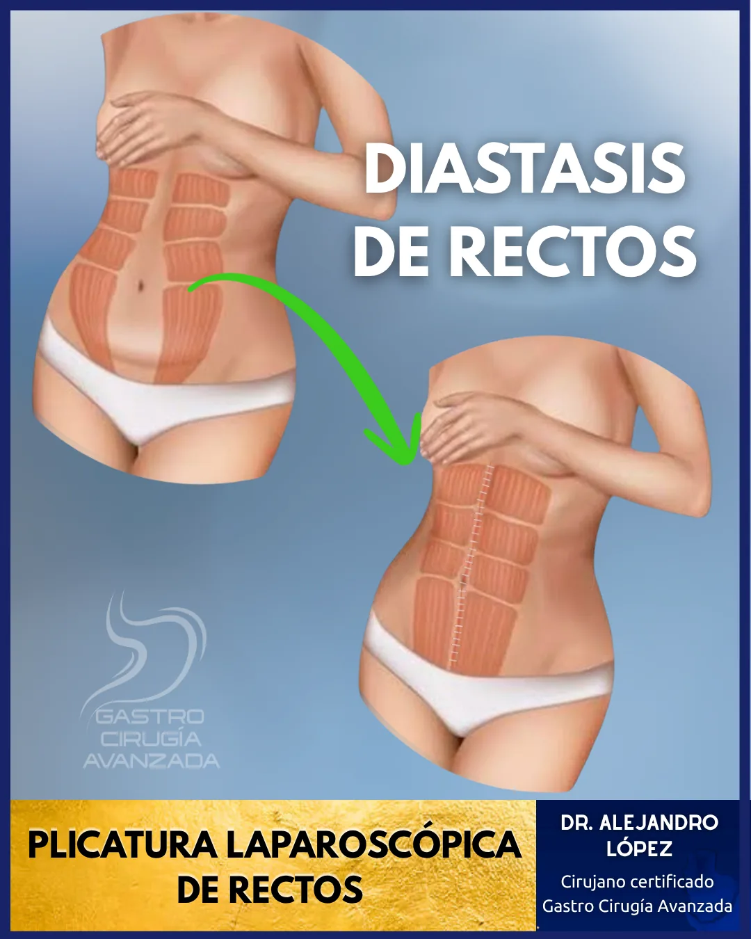Reparación de diástasis de rectos laparoscópica en México — Dr. López