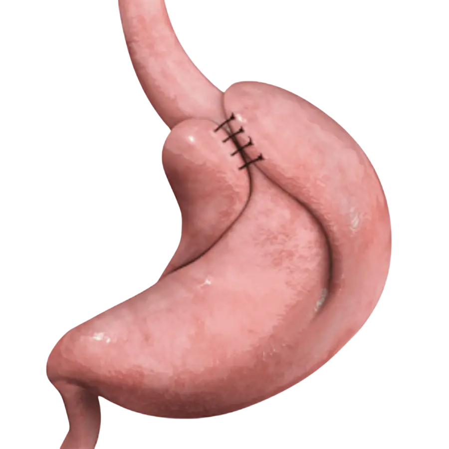Funduplicatura de Nissen para reflujo y hernia hiatal