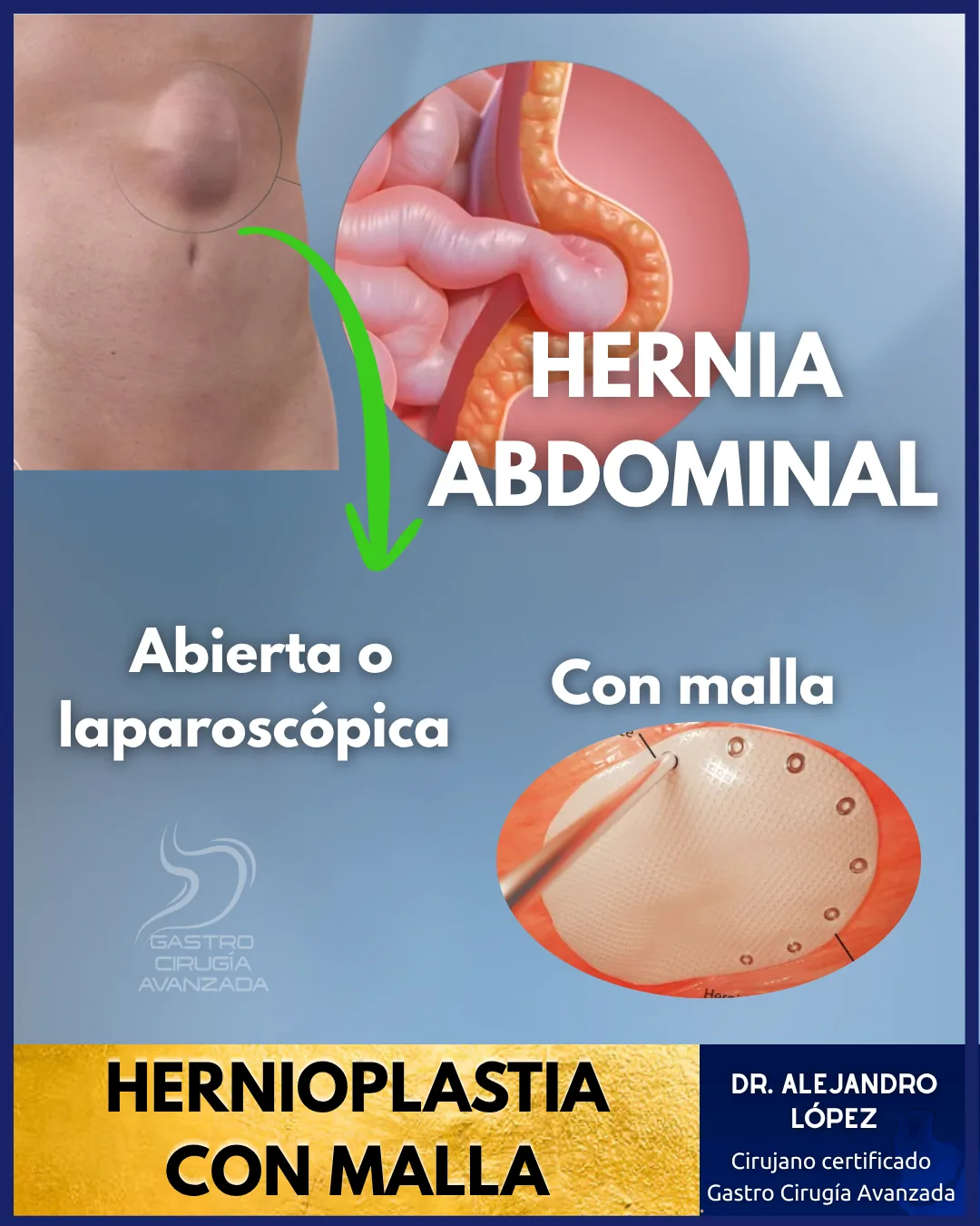 Hernia Abdominal — Hernioplastia Laparoscópica Guadalajara