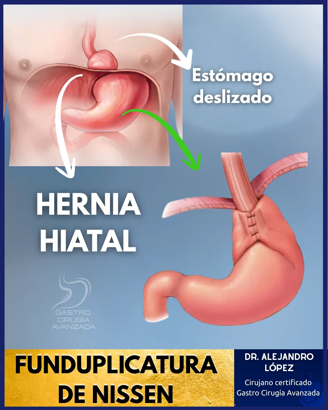 Hernia Hiatal — Hernioplastia Laparoscópica Guadalajara