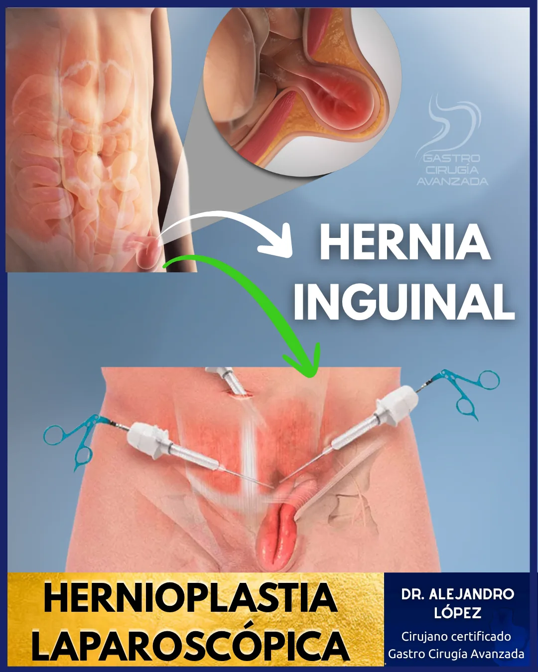 Hernia Inguinal — Hernioplastia Laparoscópica Guadalajara