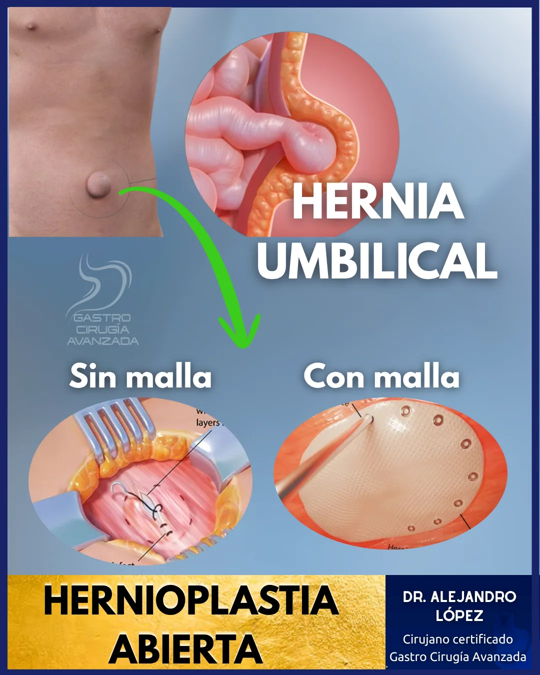 Cirugía hernia umbilical laparoscópica Guadalajara Dr. López