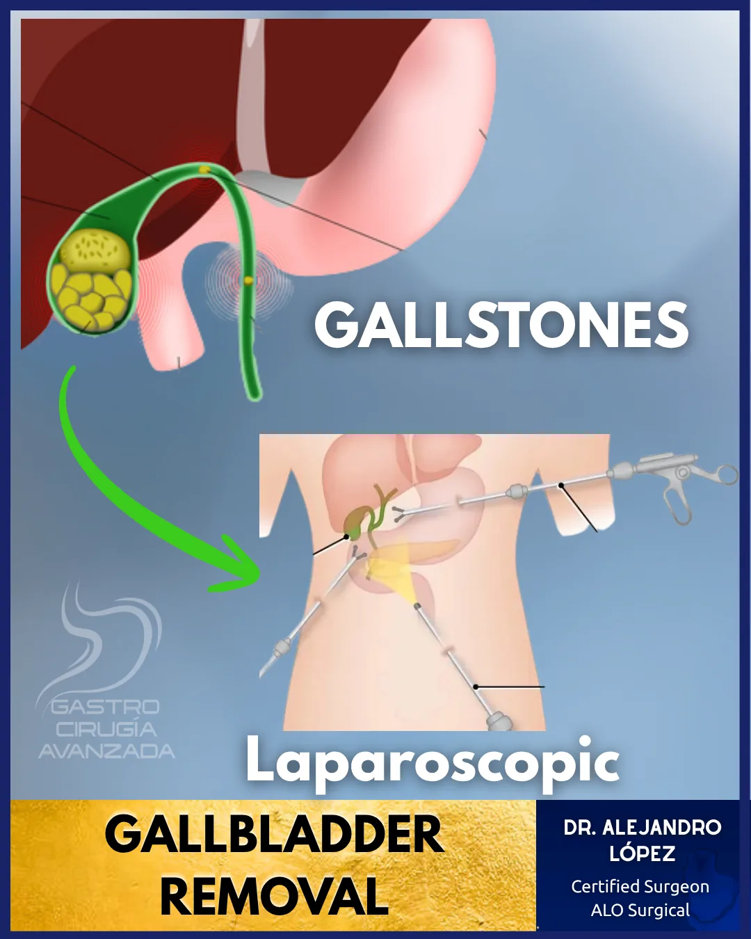 Laparoscopic cholecystectomy for gallstones in Mexico