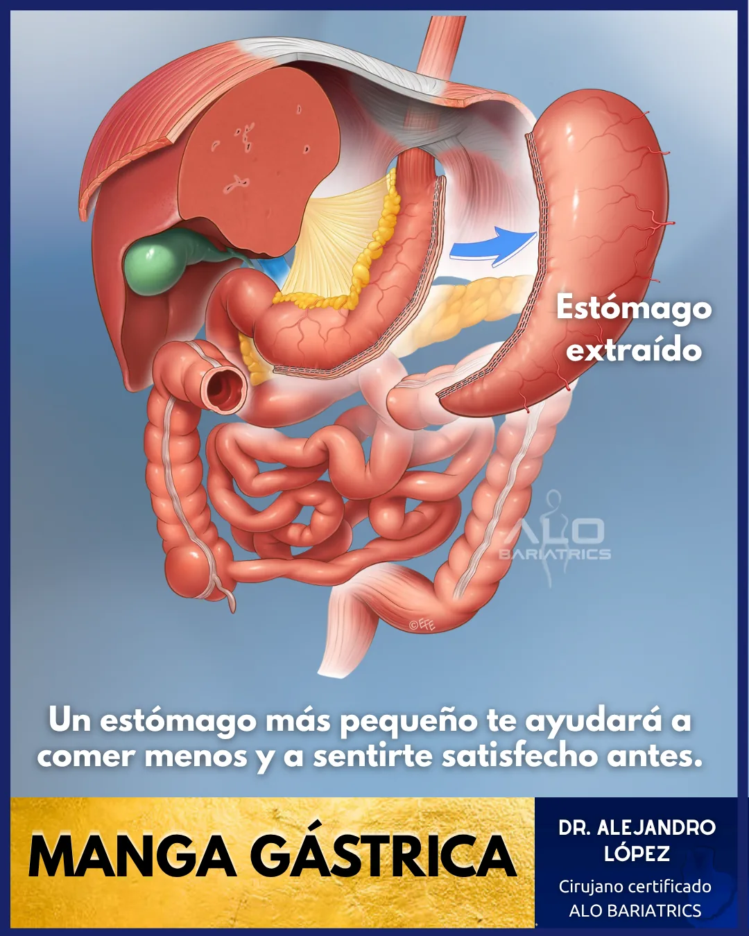 Manga gástrica en México
