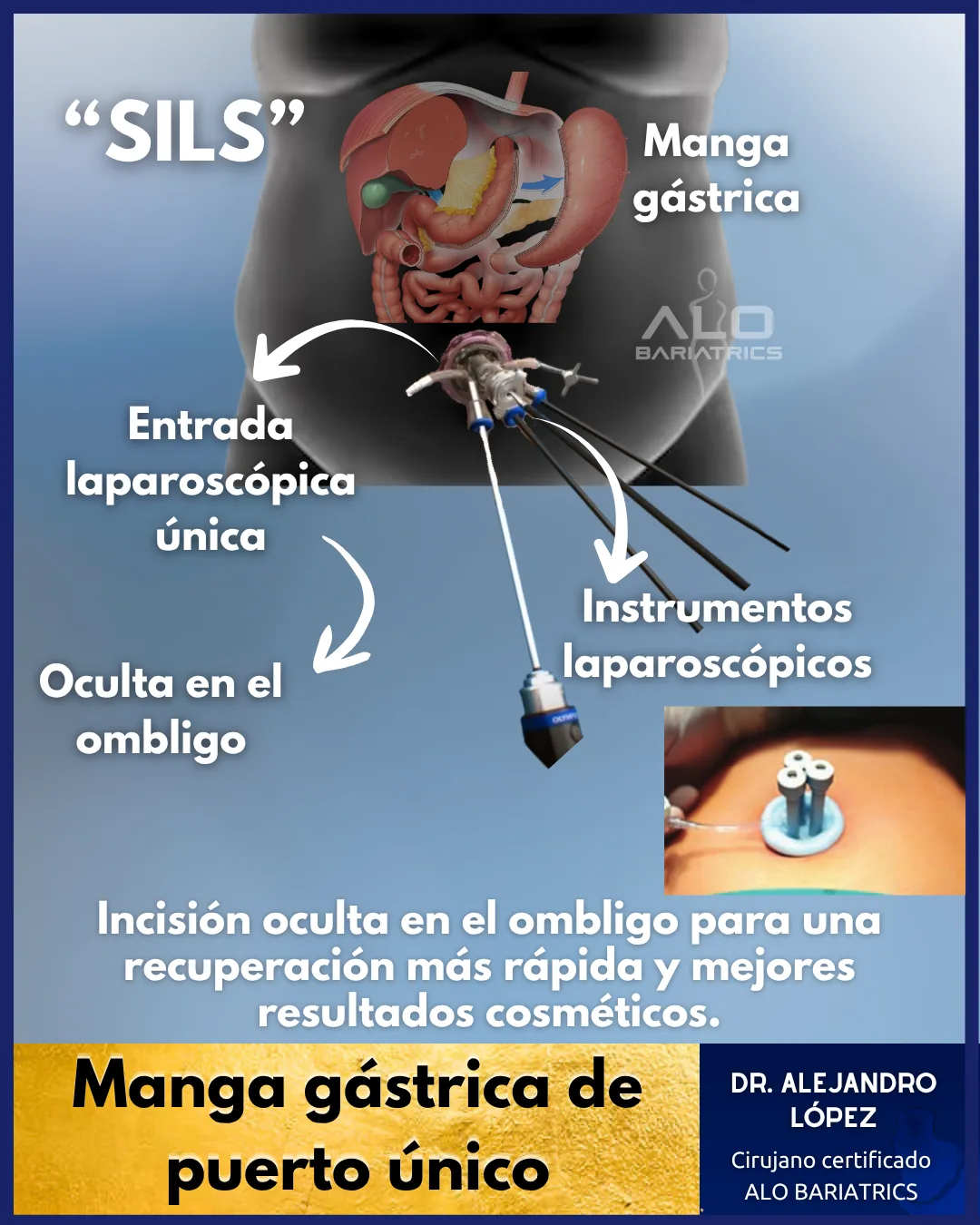 Manga gástrica SILS en México