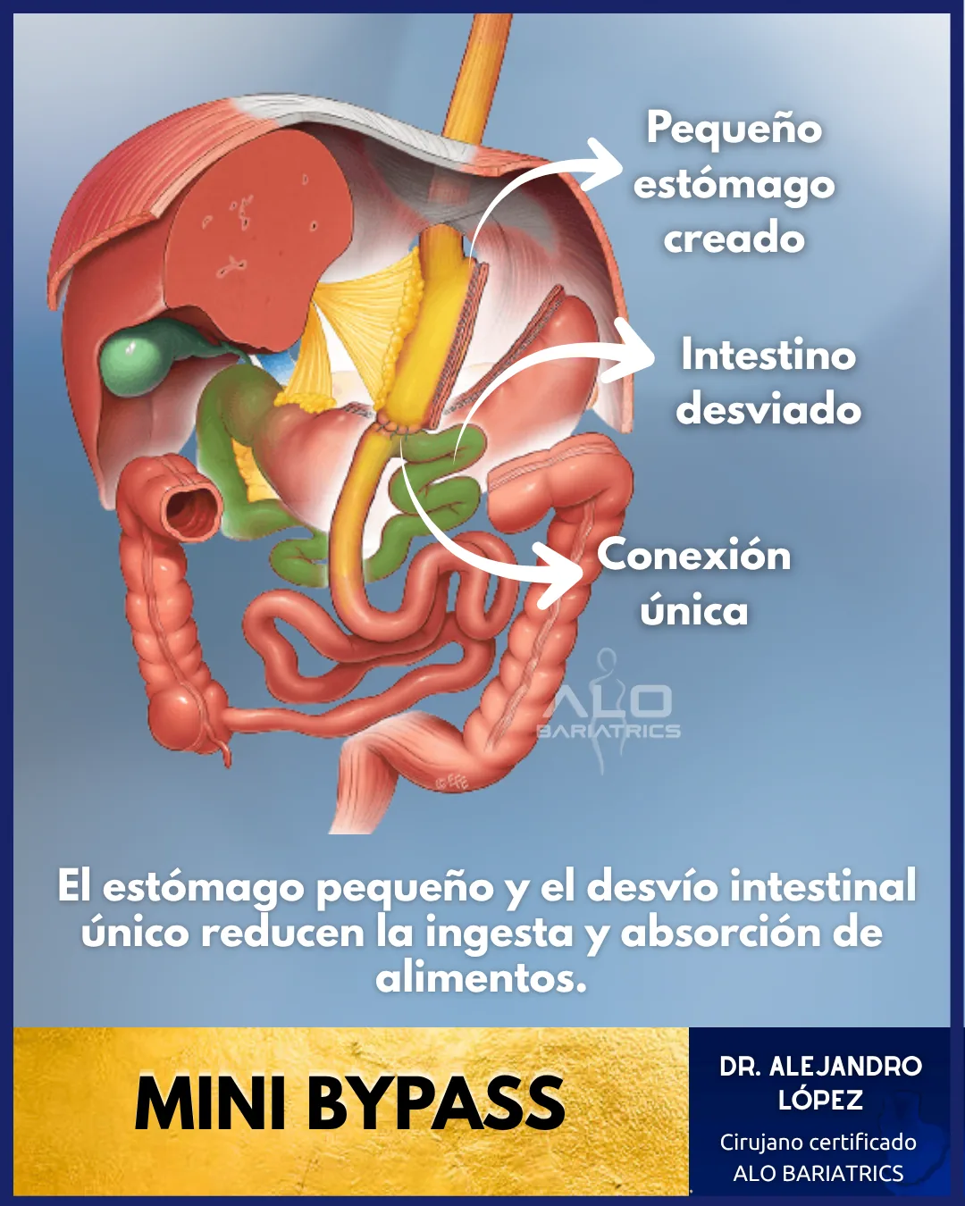 Mini bypass gástrico en México