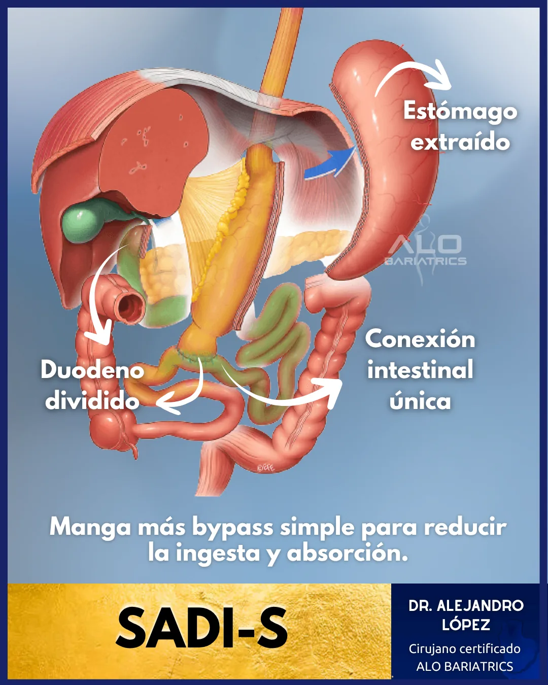 SADI-S en México