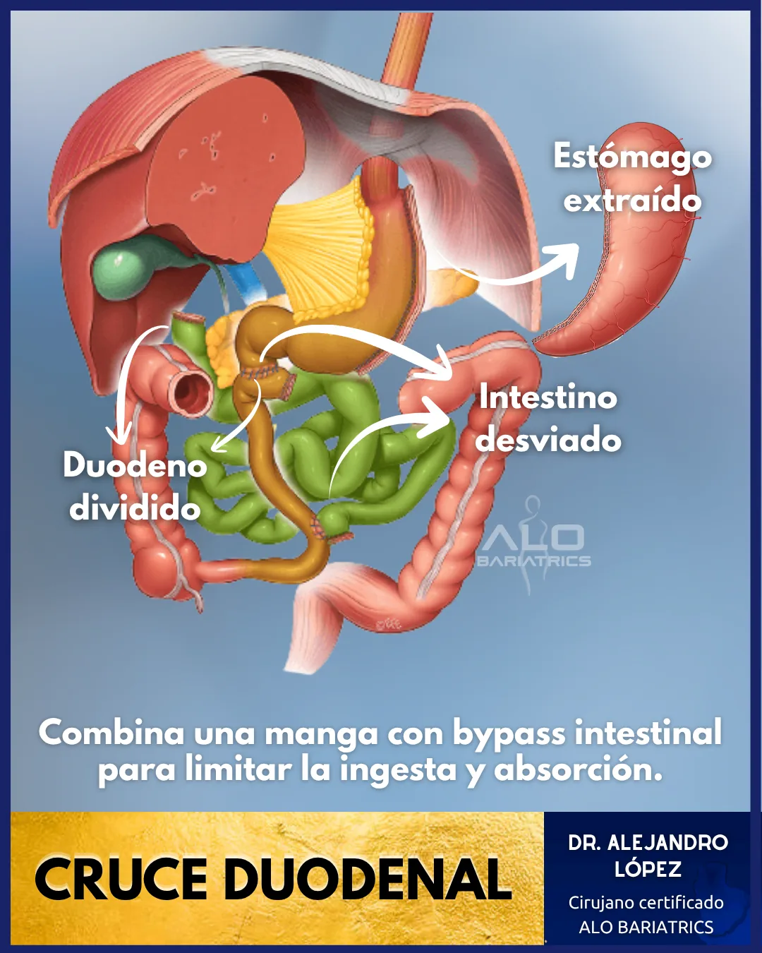 Cruce duodenal en México