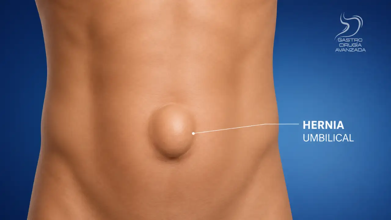 Hernia umbilical